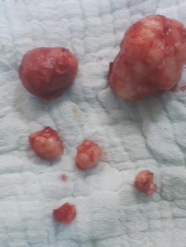 Almanya'da çare bulamadı! Sağlığına Diyarbakır'da kavuştu: 6 tane çıkarıldı - Resim: 1