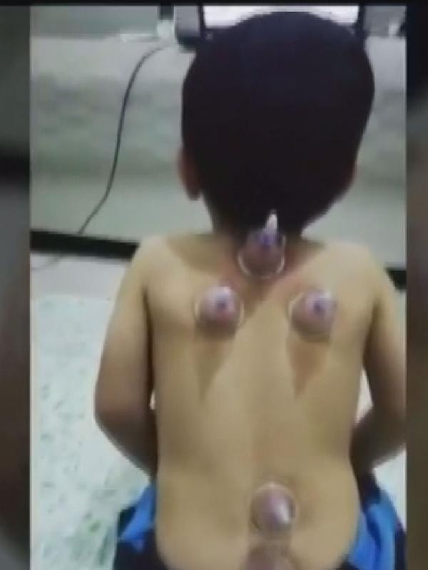 Bebeklere 'hacamat' görüntüleri tartışma yarattı! Uzmanından uyarı - Resim: 0