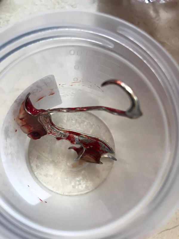 Afyonkarahisar'da olmaz denilen oldu! Boğaz ağrısıyla gitti gerçeği öğrenince şok oldu - Resim: 0