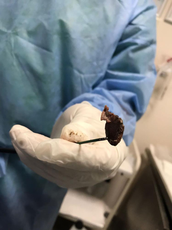 Karabük'te öksürük şikayetiyle gitti! Akciğerinden bakın ne çıktı: Doktorlar şaştı kaldı - Resim: 0