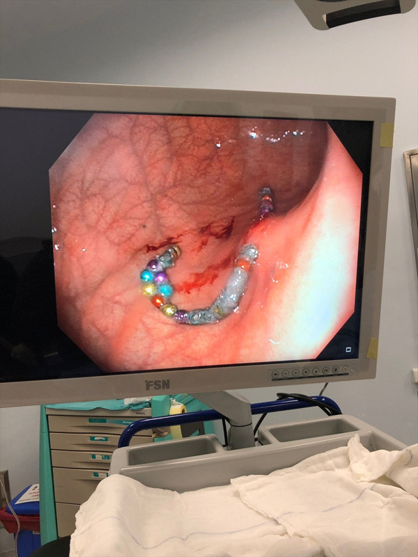 Denizli'de küçük çocuğun midesinden 17 tane çıkarıldı! Doktorlar şaştı kaldı: Çok tehlikeli bir durum - Resim: 0