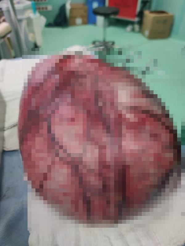 Isparta'da yorgunluk şikayetiyle gitti gerçeği öğrenince pişman oldu! Doktorlar şaştı kaldı: Vücudundan bakın ne çıktı - Resim: 1