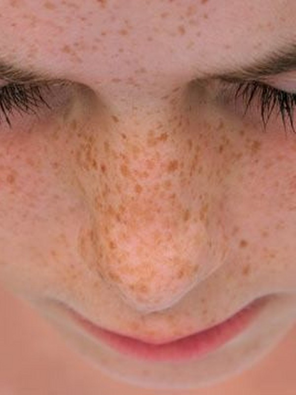 Çillere elveda.. Çilleri yok eden 8 doğal yöntem - Resim: 0