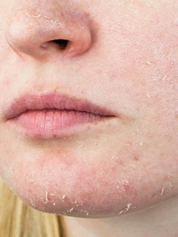 Soğuk havanın cildinizdeki etikisine inanamayacaksınız! Cildinizi kışa hazırlayın... - Resim: 0