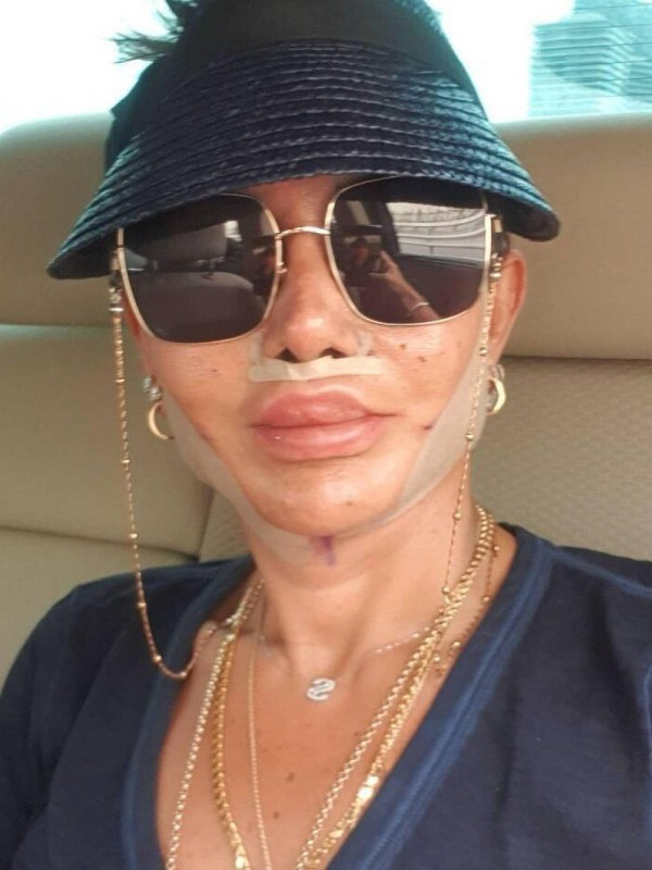 Serap Paköz estetik yaptırdı tanınmaz hale geldi! Takipçileri ''Yüzüne ne yaptın'' dedi - Resim: 1