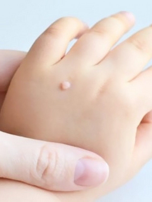 Siğillere 30 dakikada veda edin - Resim: 0