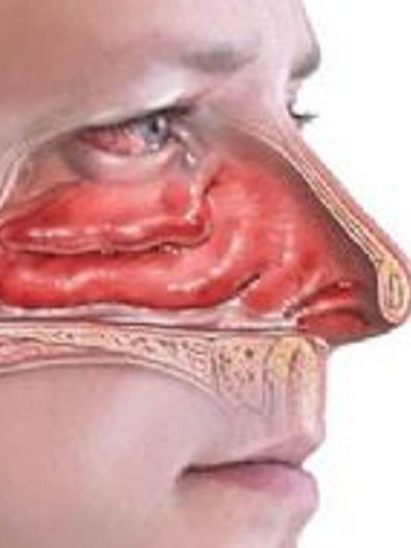 Burnunuz tıkalıysa sebebi polipler olabilir! Nazal polip nedir nasıl tedavi edilir? - Resim: 0