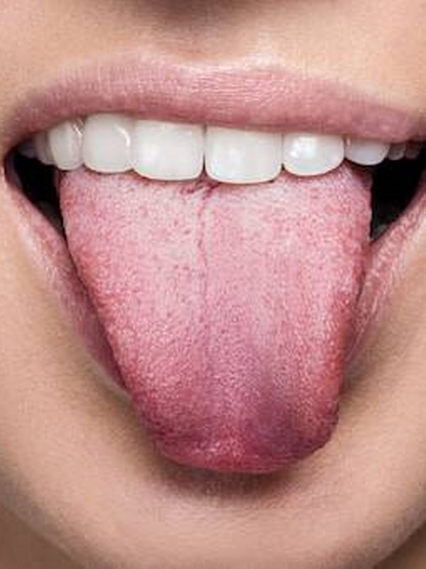 Dil rengi kanseri ele veriyor dilinizdeki değişimleri kontrol edin - Resim: 0