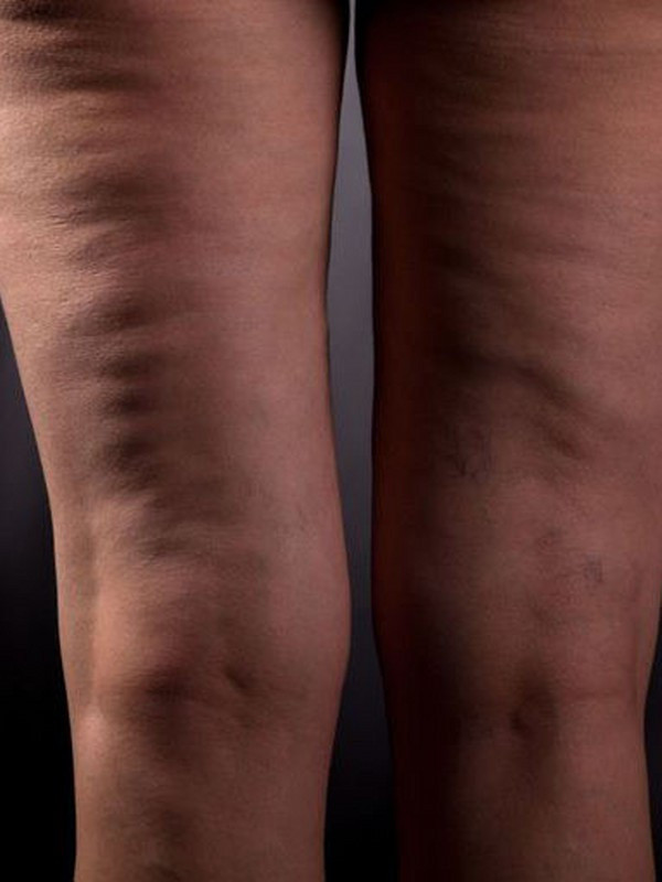 Bu yöntemlerle pürüzsüz bacaklara sahip olabilirsiniz! Selülitlere veda - Resim: 0