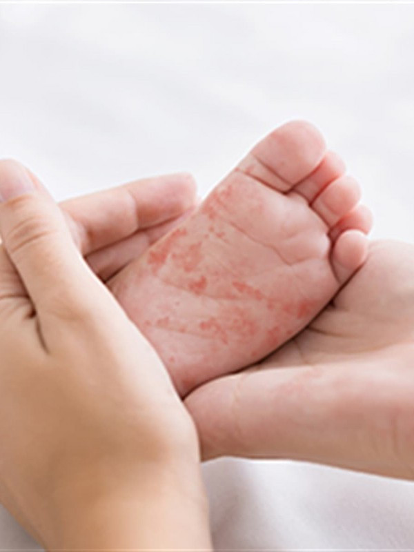 Bebekleriniz pişik yüzünden acı çekmesin! Pişiği geçiren yöntemler... - Resim: 0