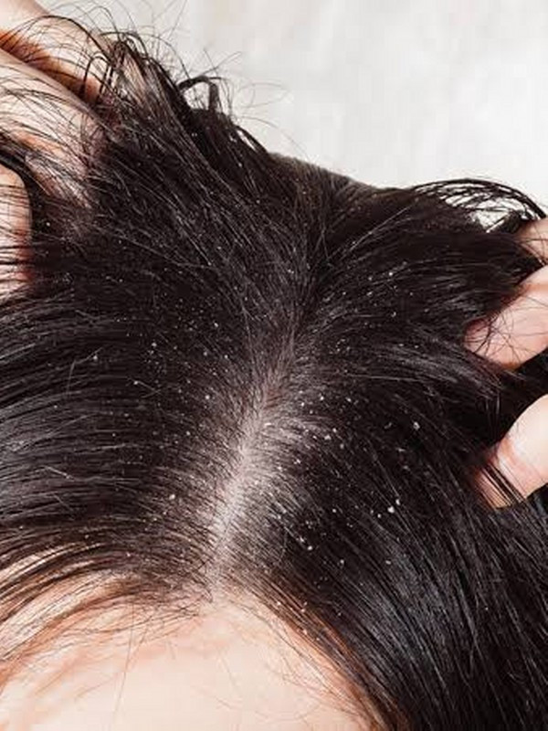 Her gün yıkıyorum saçlarım yine yağlanıyor diyenlerseniz çözümü basit! - Resim: 1