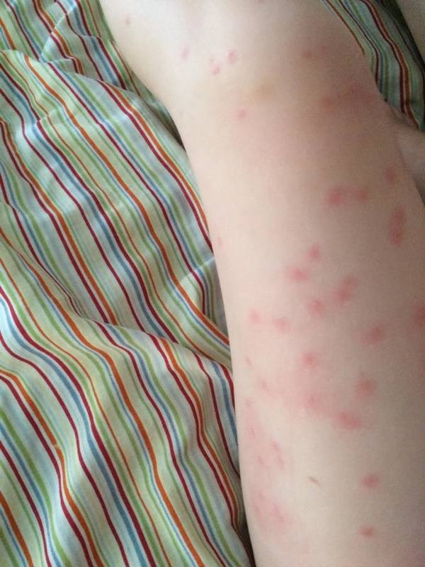 Kızının tırnağında siyah bir nokta fark etti hemen hastaneye koştu - Resim: 4