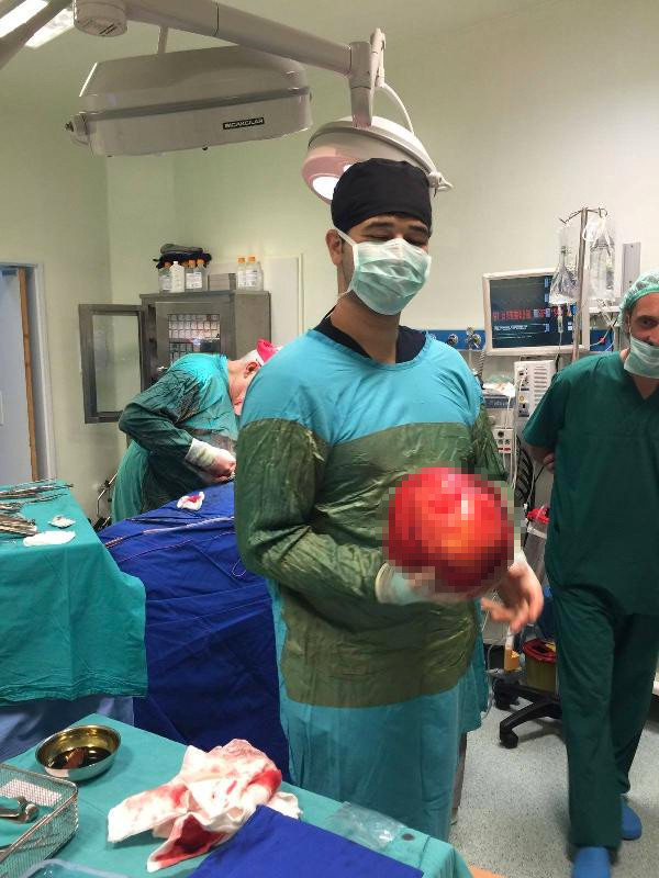 50 yıllık birliktelik ameliyatla son buldu! - Resim: 3