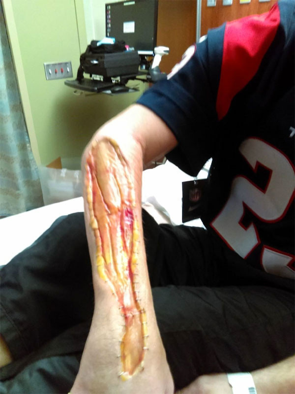 Et yiyen bakteri kolunu yiyor 1 haftada kolunun yarısı gitti - Resim: 4