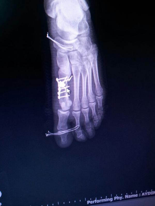 Sağlam parmağa ameliyatta ikinci perde! - Resim: 3