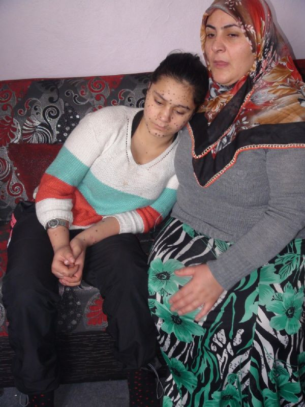 Cilt kanserine yakalandı - Resim: 4