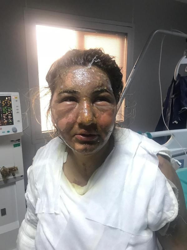 İstanbul'da vahşet! Cezaevinden izinli çıktı eski eşini yağ ile yaktı - Resim: 4