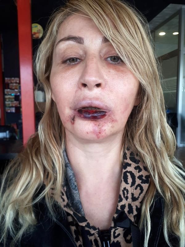 4 kez dolgu yaptırdığı alt dudağı koptu! Şimdi yeniden yaptırıyor - Resim: 2