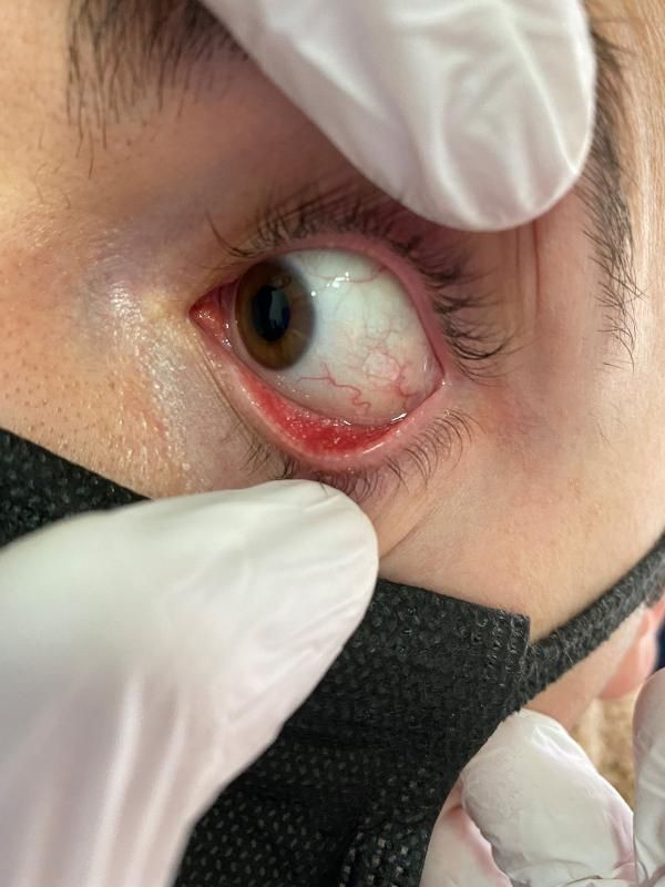 Korona bitmeden gözlerde virüs salgını başladı! Adenovirüs nedir kör eder mi? - Resim: 3