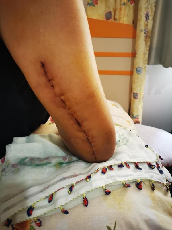 Sevgilisinin kolunu kıran sanığa tahrik ve iyi hal indirimi - Resim: 3