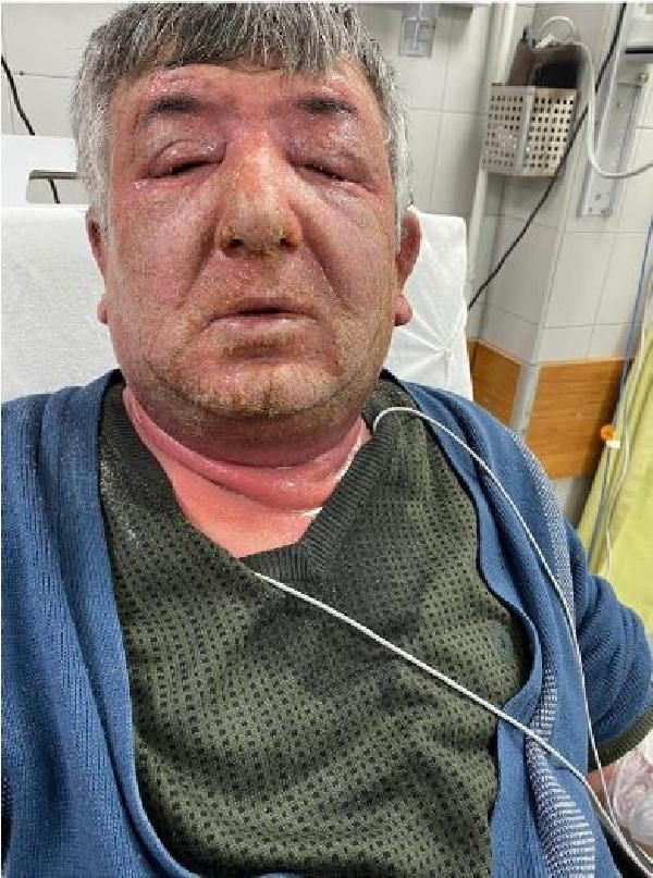 Ankara'da hayatının hatasını yaptı gözleri kapandı! Öldürecek gibi kaşıntı - Resim: 2