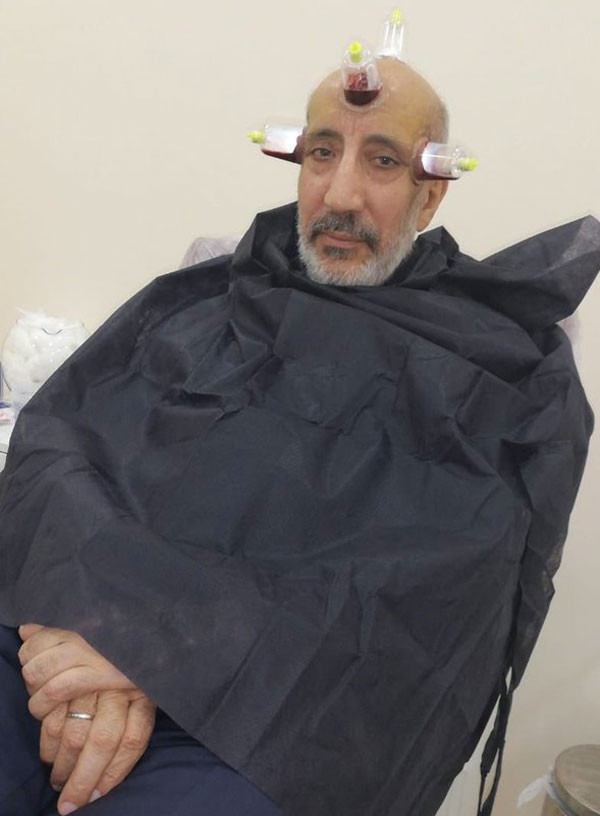 Abdurrahman Dilipak kendine ne yapmış öyle göz için hacamat yapılır mı? - Resim: 4