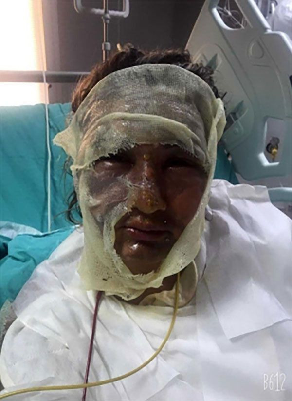 İstanbul'da yüzünü kızgın yağla yakan sevgilisi tutuklanınca affedin diye ağladı - Resim: 4