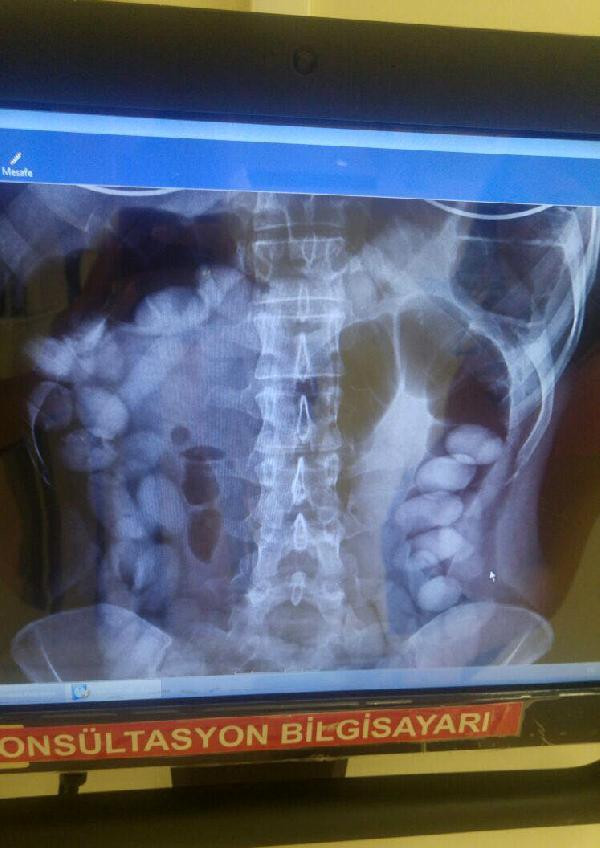 Antalya havaalanında yakalandı midesinden çıkana bakın - Resim: 2