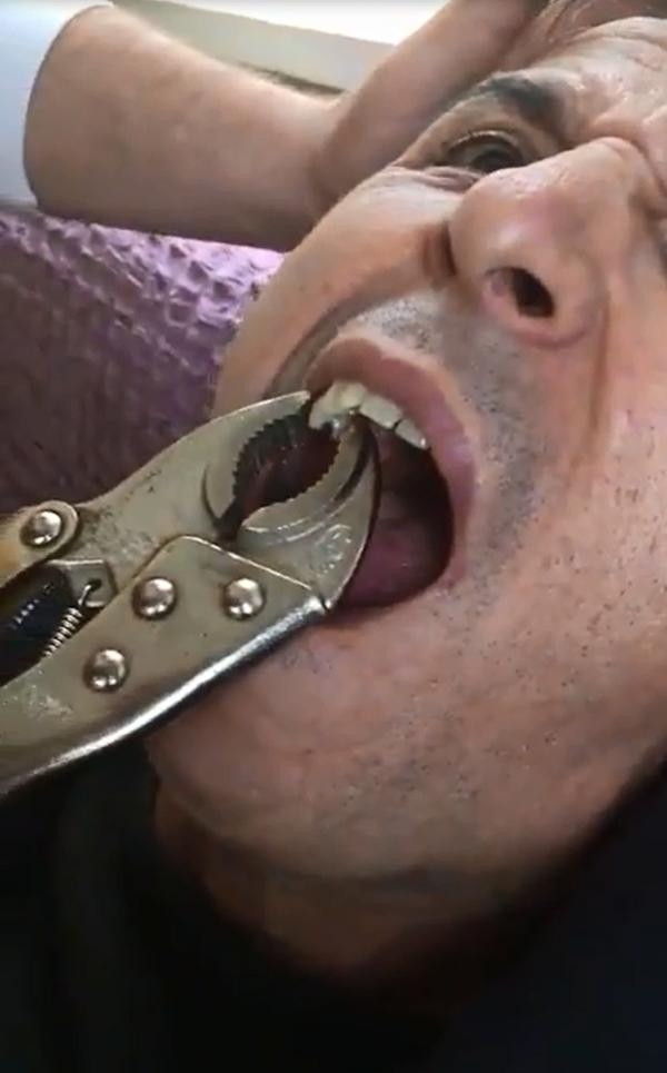 Bu video rekor kırıyor çürüyen dişini penseyle çektirdi! - Resim: 2