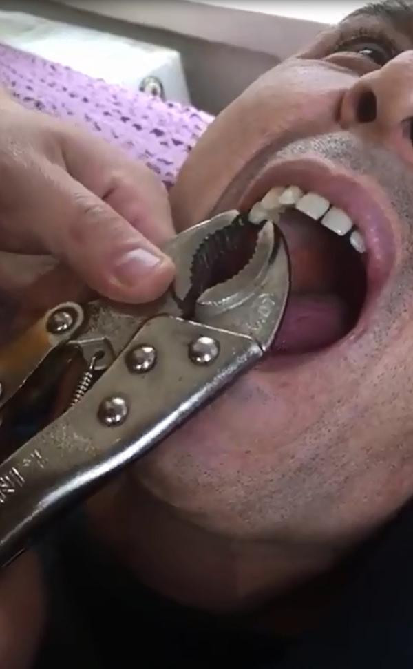 Bu video rekor kırıyor çürüyen dişini penseyle çektirdi! - Resim: 3