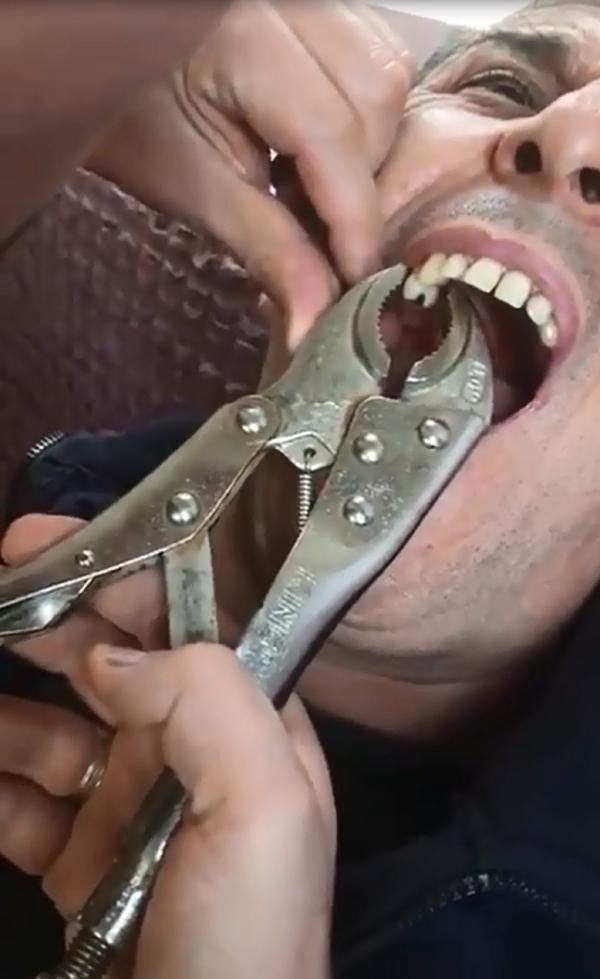 Bu video rekor kırıyor çürüyen dişini penseyle çektirdi! - Resim: 4