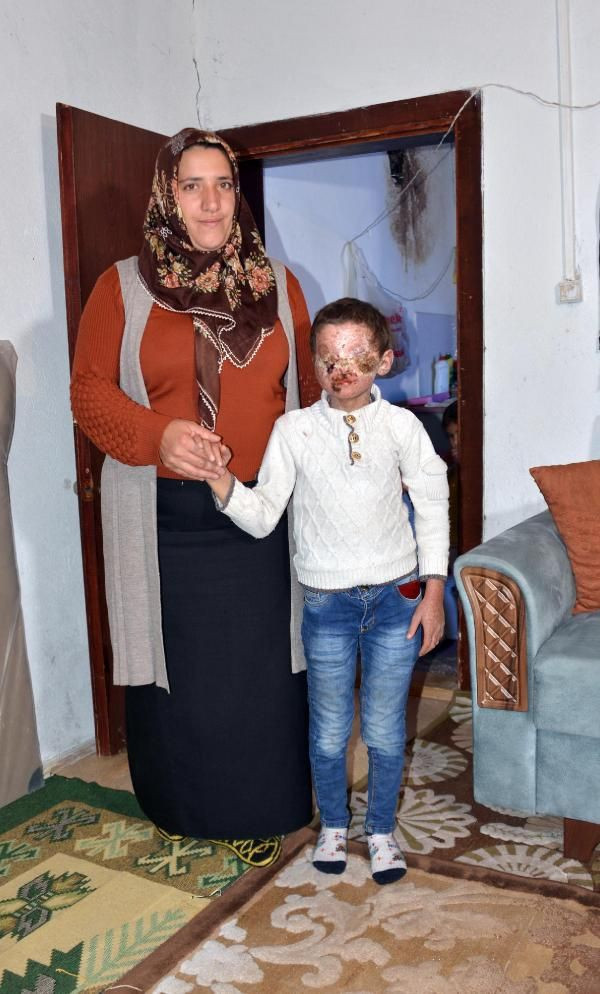 Erzurumlu 8 yaşındaki Salih güneşe çıkabilecek! Cilt kanseri yüzünü bu hale getirmişti - Resim: 2