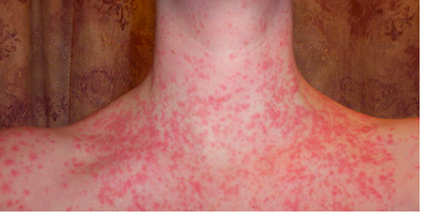 Vücutta lekeler neden olur-kırmızı leke neyin belirtisi? - Resim: 2