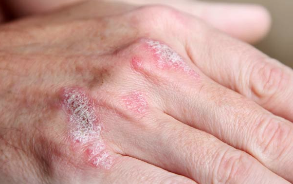 Sedef hastalığı nedir tedavisi var mıdır? - Resim: 3