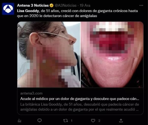 Bademcik iltihabı zannetti hayatının şokunu yaşadı! 3 çocuk annesi şimdi içler acısı halde - Resim: 1