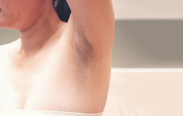 Koltuk altı kararması nedir? Kararmayı gidermek için 3 basit yöntem - Resim: 1