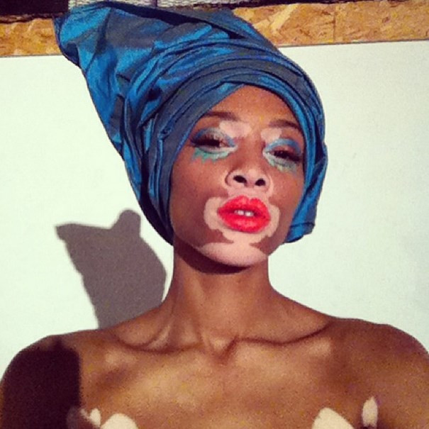 Vitiligo hastası genç kız manken oldu - Resim: 1