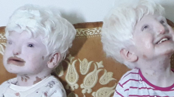 Albino kardeşler yardım bekliyor!  - Resim: 2