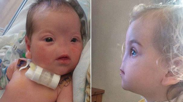 Burnu olmadan doğan bebek - Resim: 1