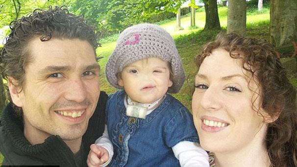 Burnu olmadan doğan bebek - Resim: 4