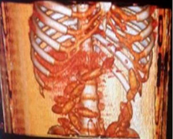 Sindirim sisteminde 115 prezervatif bulundu - Resim: 1