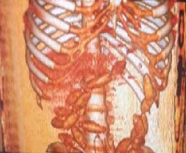 Sindirim sisteminde 115 prezervatif bulundu - Resim: 4