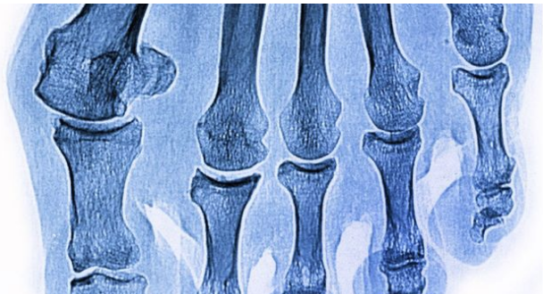 İşte kırıklar hakkında doğru bildiğimiz 5 yanlış! - Resim: 2
