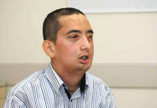 İşte 2. tam yüz nakli yapılan genç  - Resim: 2