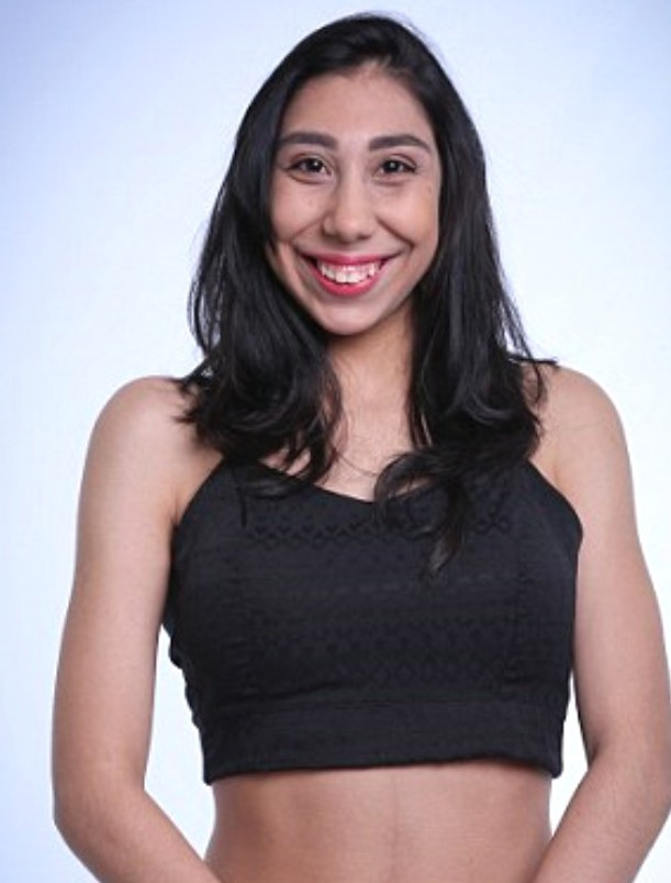 Doktorlar asla yürüyemez dedi o şimdi manken oldu - Resim: 4