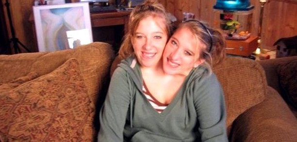 Tek vücutta iki kişi yaşıyorlar! Son halleri... - Resim: 1