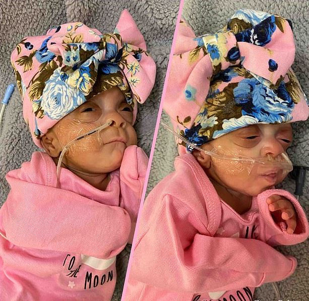 ABD'de mucize gerçekleşti! Doktorların yaşamaz dediği ikizler dünyaya gözlerini açtı - Resim: 0