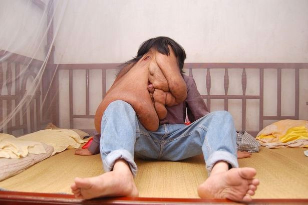 Görüntüsü herkesi ürkütüyor! Fil adamın yaşadıkların bakın - Resim: 3