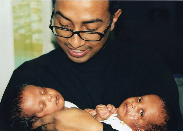 Doktorların yaşamaz dediği mucize ikizler 16 yaşına girdi - Resim: 1