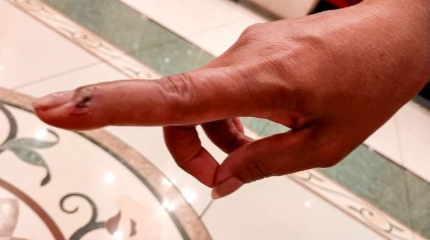 Tuvaletini yapan kadın hayatının şokunu yaşadı! 2 metrelik yılan ısırdı - Resim: 4